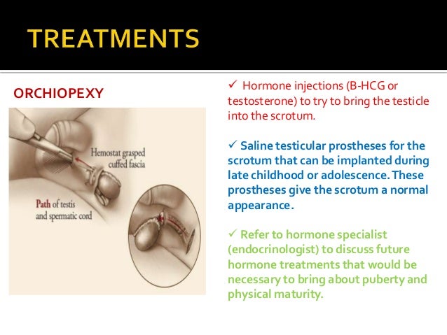 Saline Injections Scrotum Saline Injections Scrotum